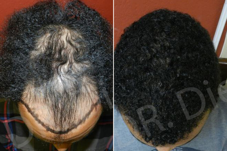 Ideal Candidates for Hair Transplants for African American Hair