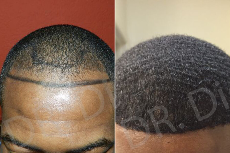 afro hair loss