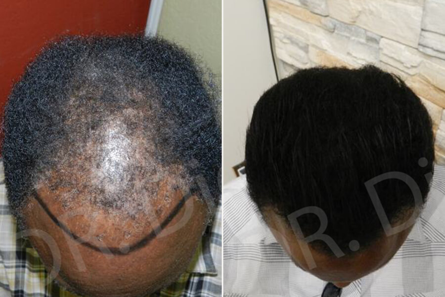 african hair growth treatment