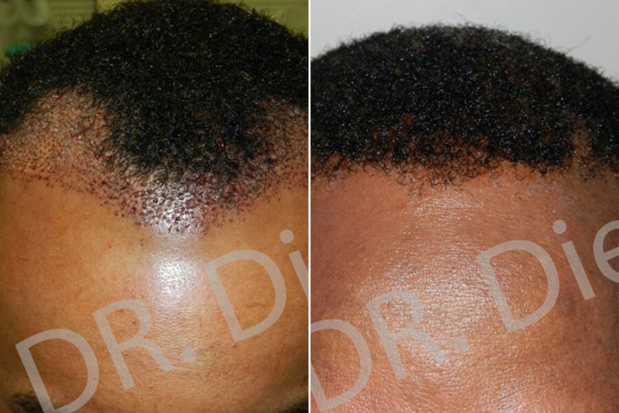 afro thinning