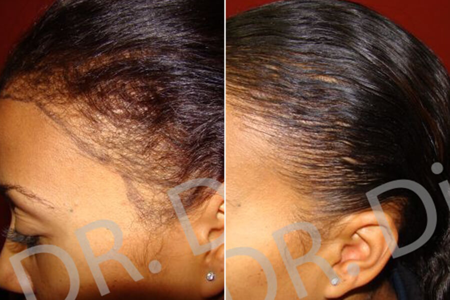 Afro Black Hair Loss