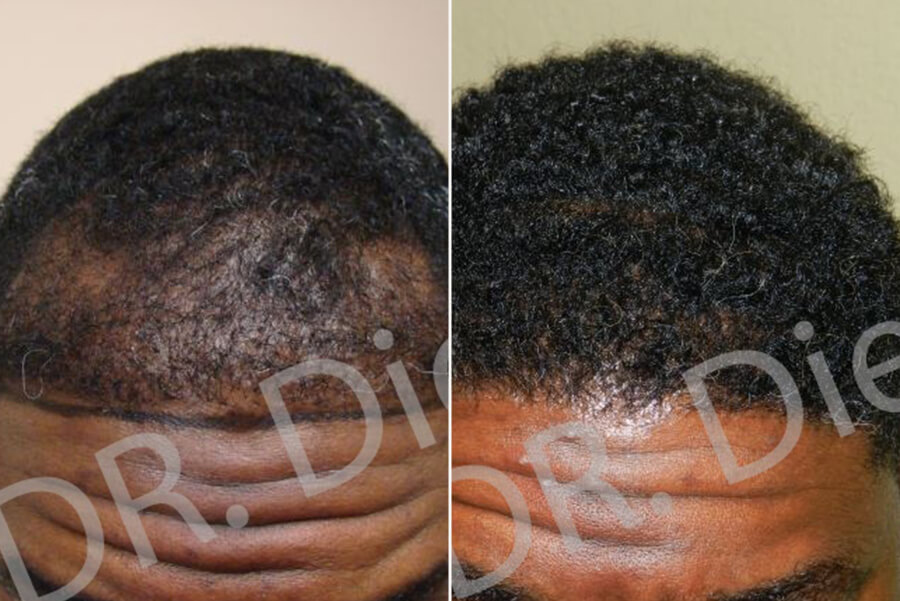 african american hair shedding