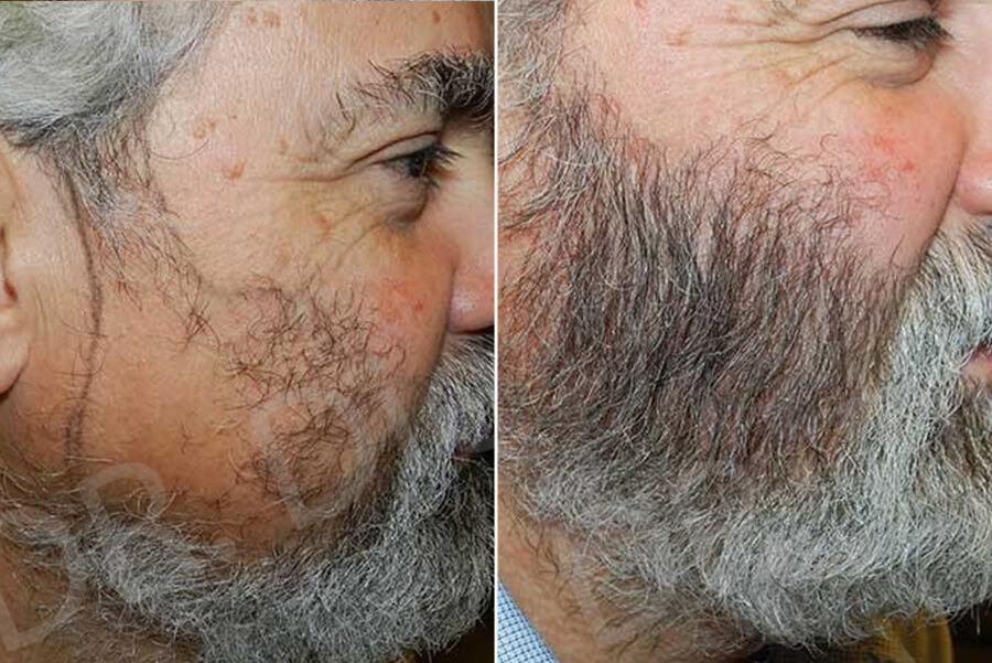 Beard, Goate, Facial Hair Replacement