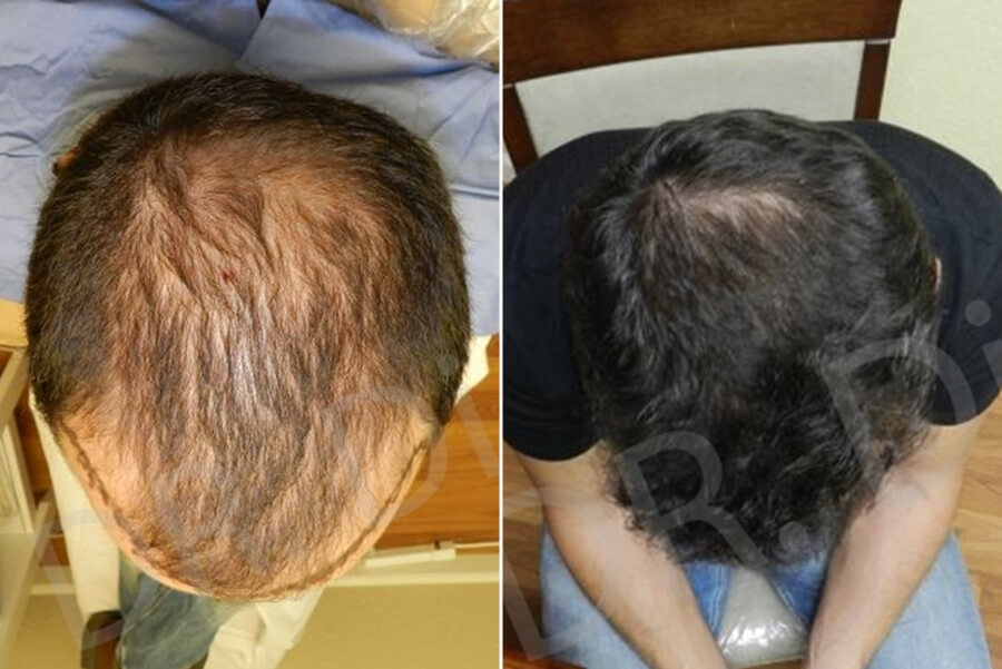 Vertex Crown Hair Transplant and Restoration