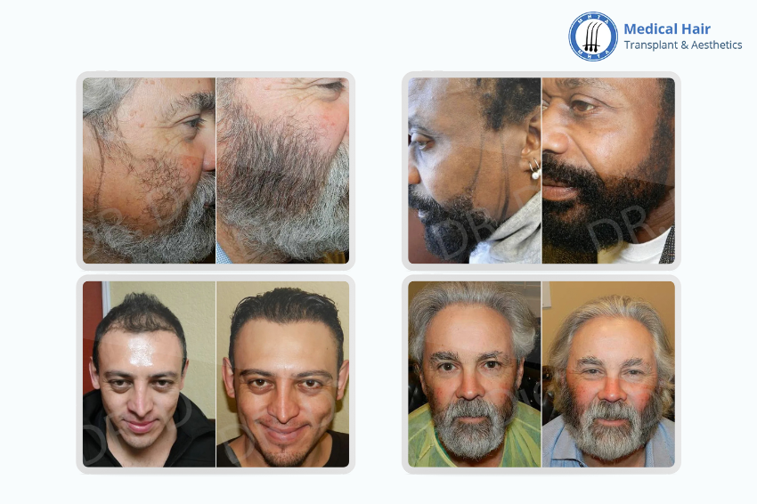  Why Choose Facial Hair Transplants for Men?