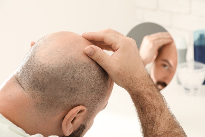 Factors That Contribute to a Failed Hair Transplant