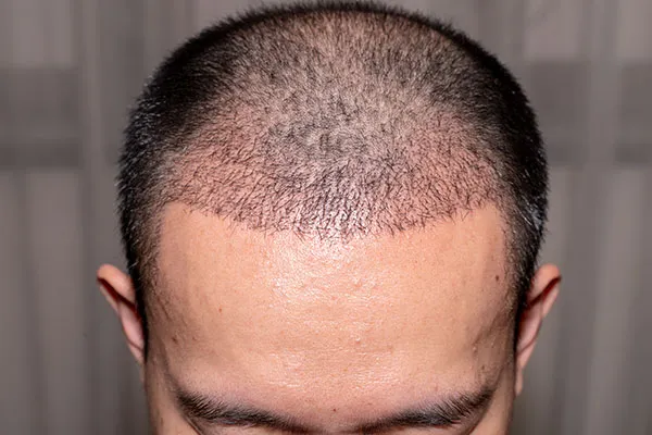 Look and Feel Your Best with FUE Hair Transplant in Canada