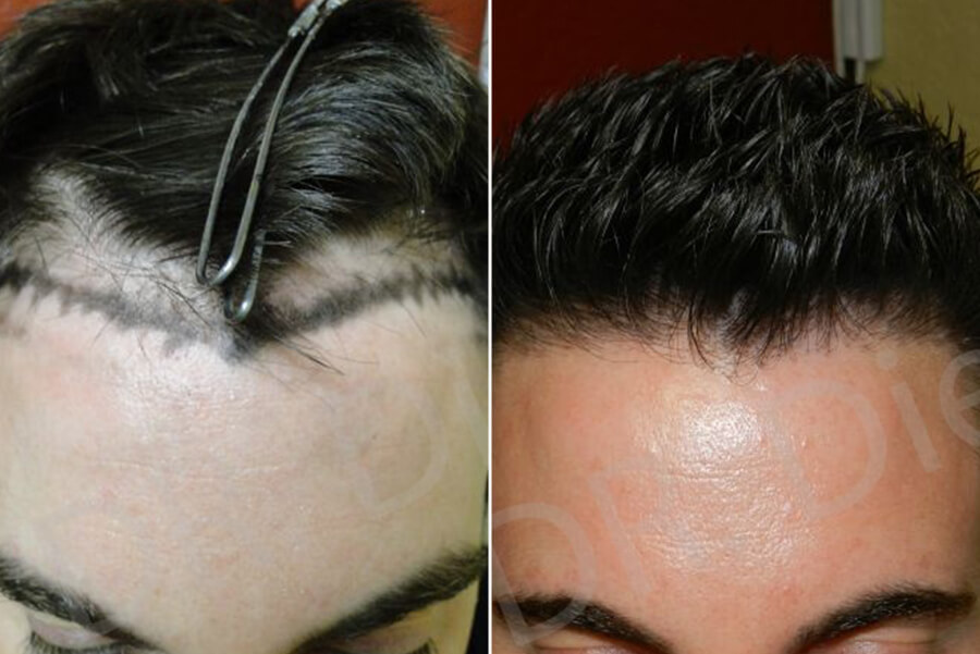 Receding Frontal Corners Hair Loss