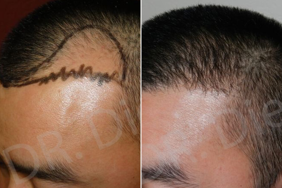 fue hair implant