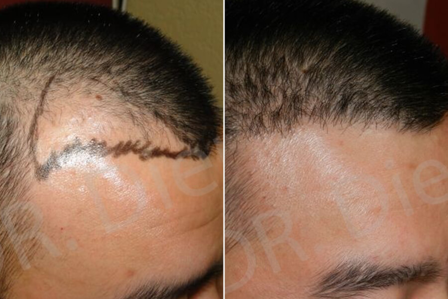 fue hair implant
