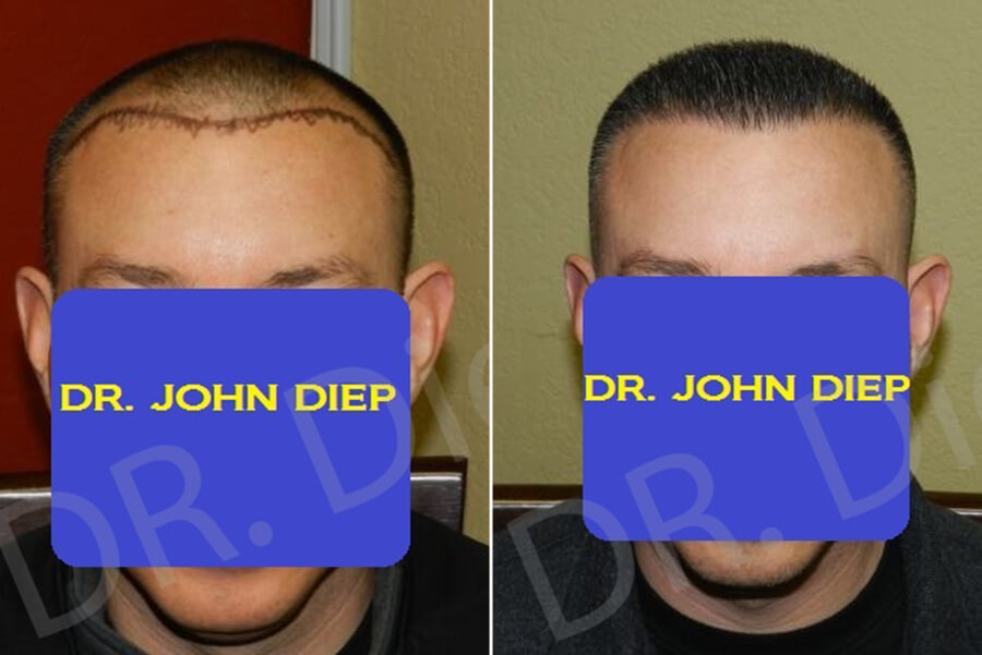 fue hair transplant before and after