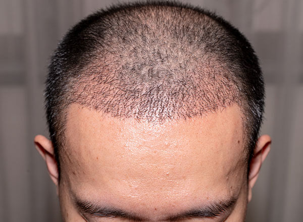 Who Is an Ideal Candidate for FUE Hair Transplant?