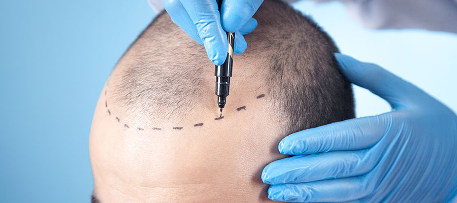 What is FUT/FUE Hair Transplant Surgery?