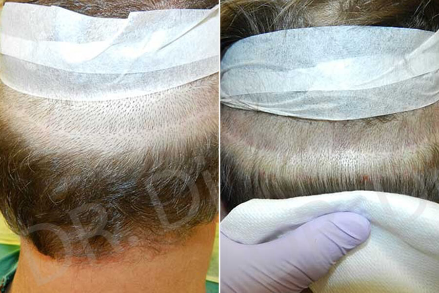 FUT Hair Transplant Donor Scar