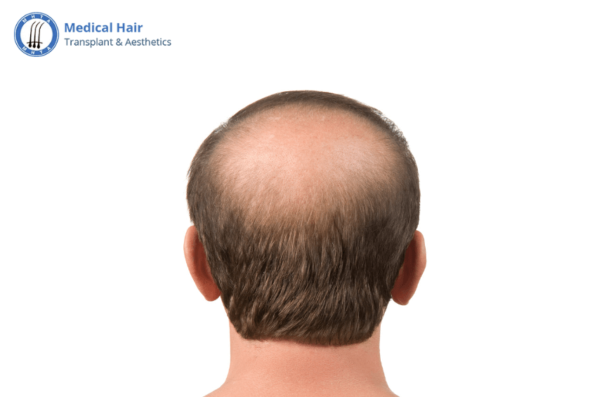 Is Baldness Hereditary? Understanding the Role of Genetics