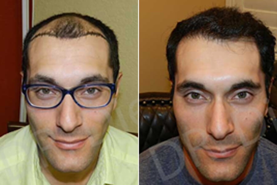 Men Hair Transplant