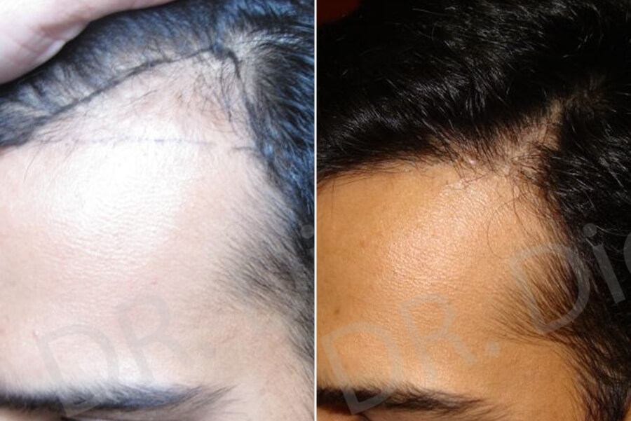 Receding Frontal Corners Hair Loss