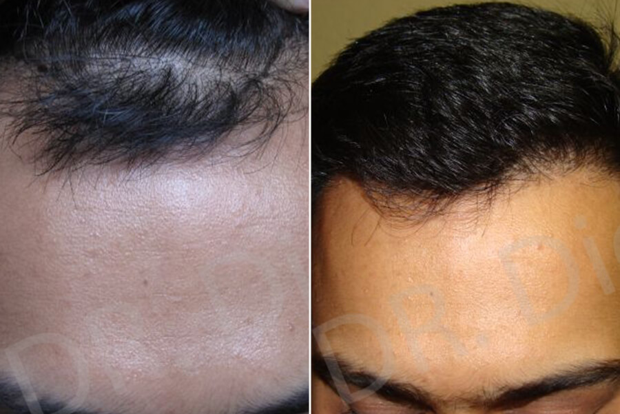 receding hairline men treatment