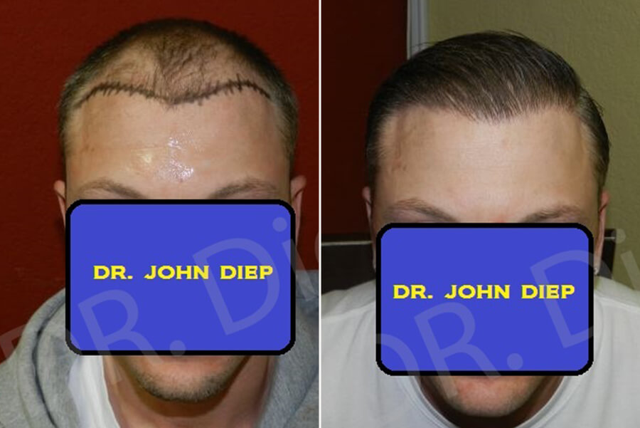 receding hairline men treatment