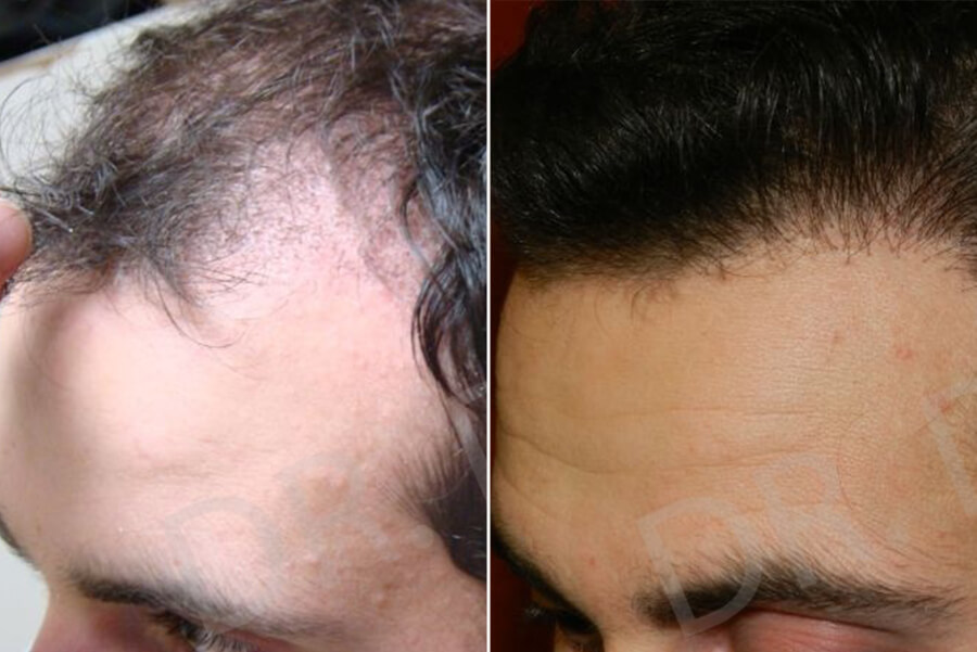 receding hairline treatment