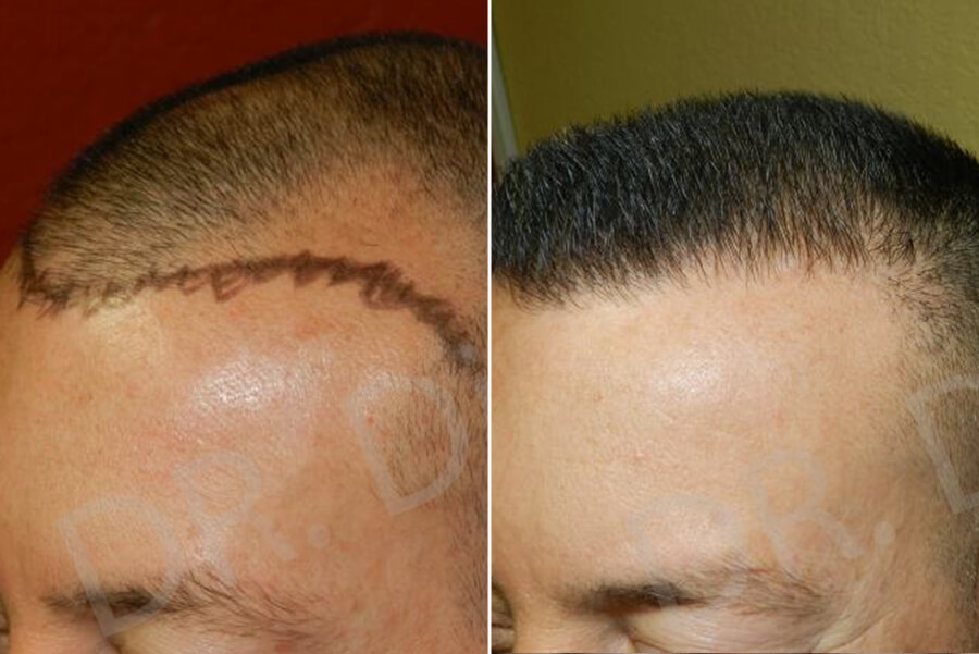 receding hairline treatment male