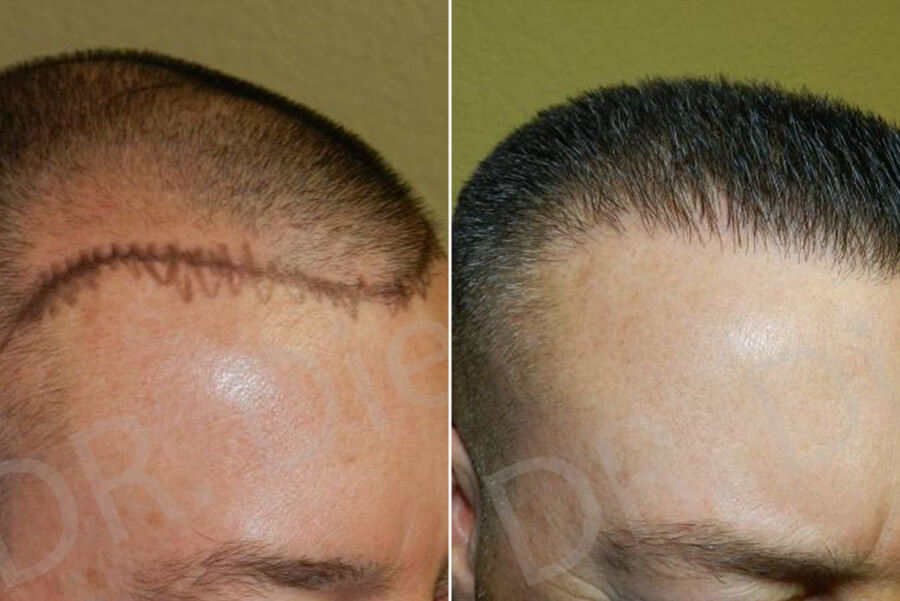 receding hairline treatment male