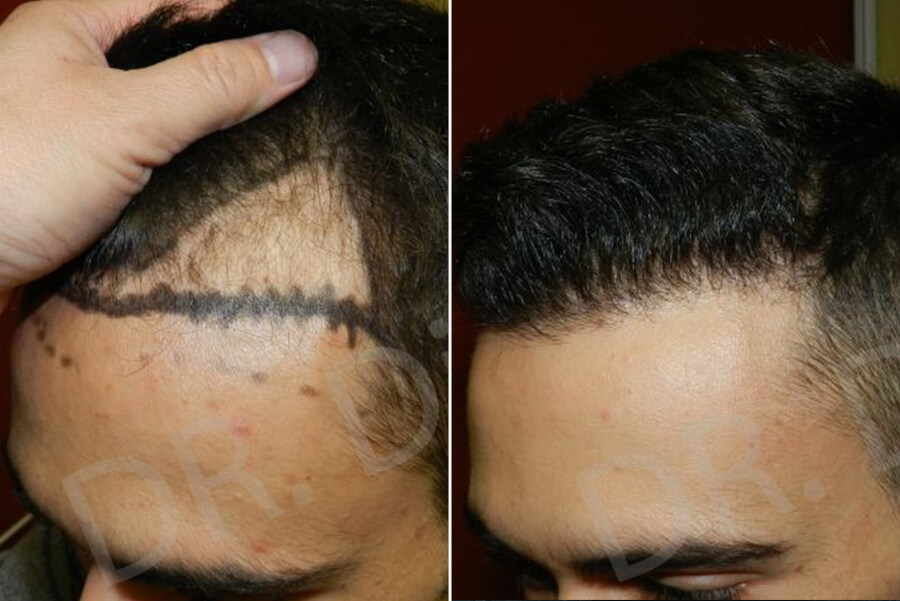 hair loss treatment for receding hairline