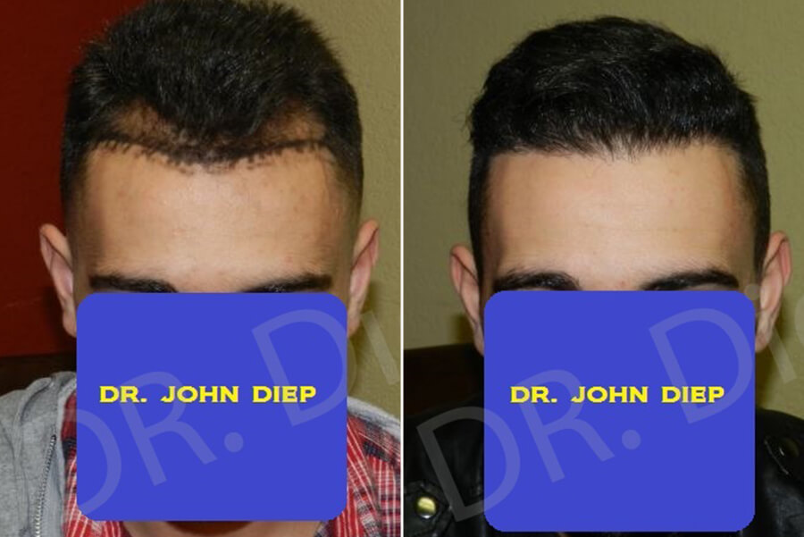 hair loss treatment for receding hairline