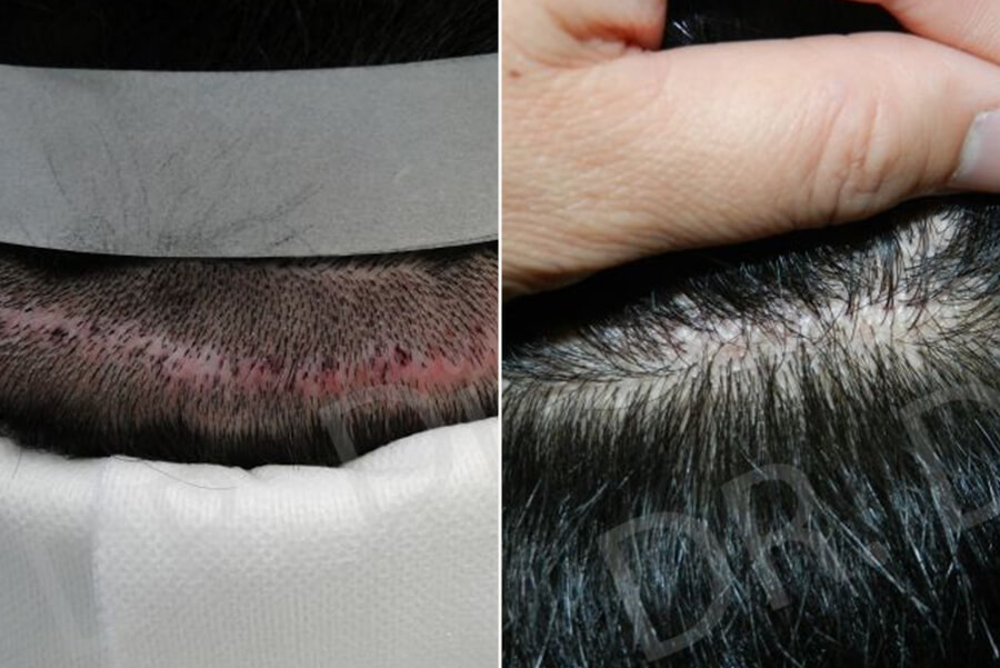 Scar Hair Plugs FUE Corrective Hair Surgery