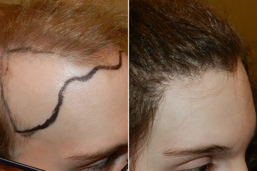 Transgender Hair Transplant Before and After