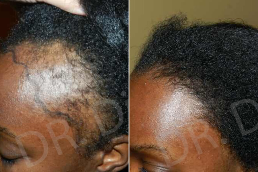 hair plantation for ladies