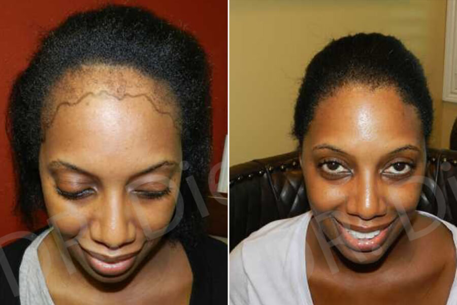 female hair implants