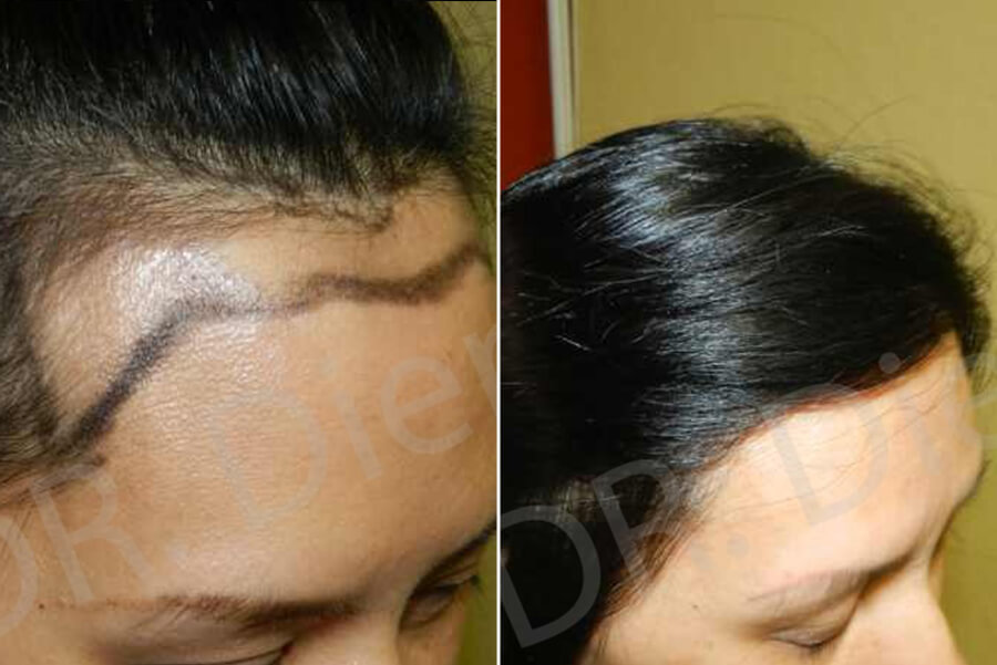 hair plantation for women