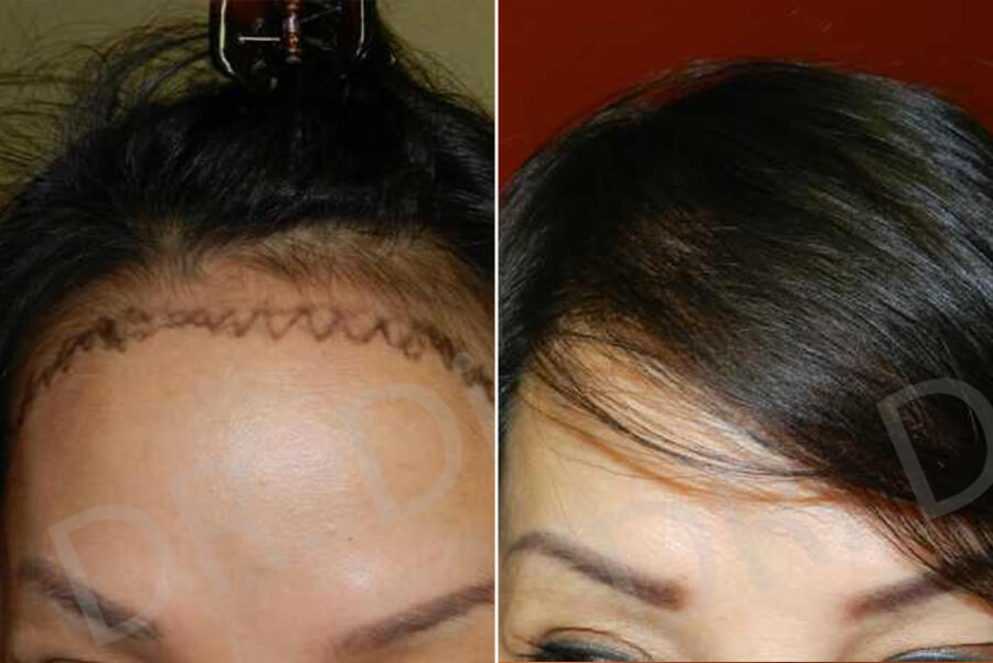 Women's Hair Transplant