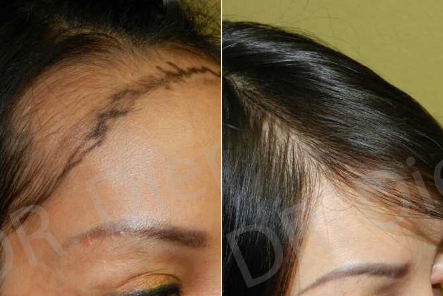 hair replacement for women