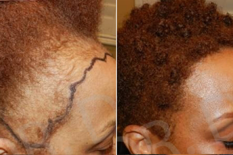 Women's Hair Transplant
