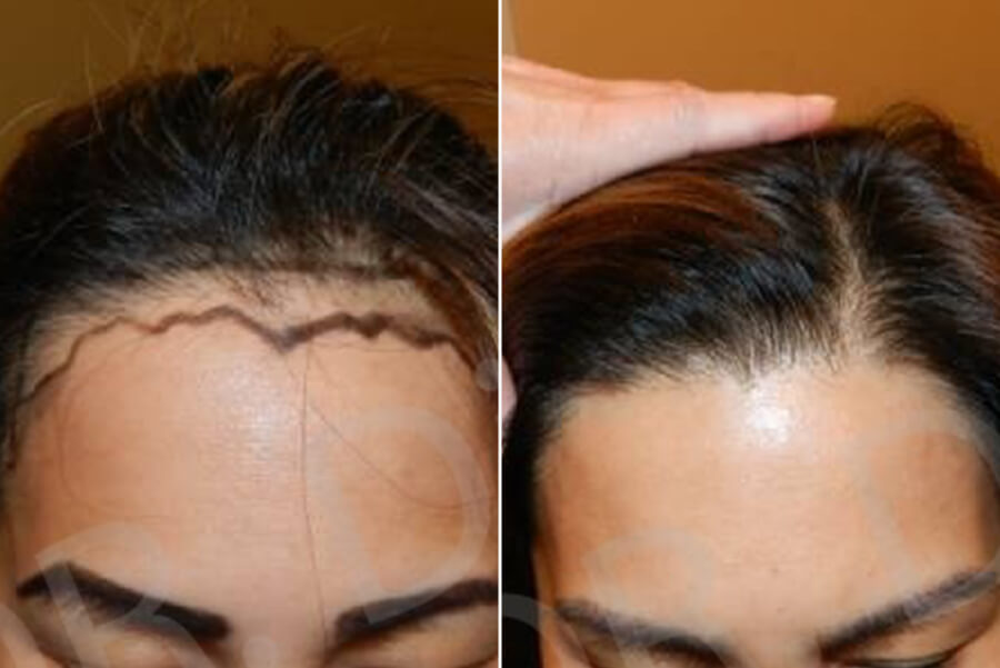female hair implants