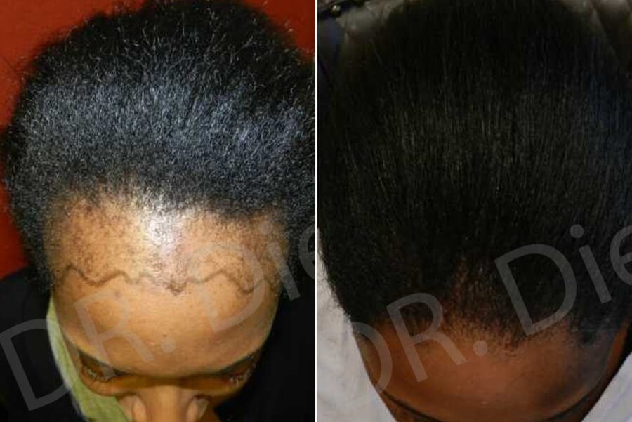 hair implant for ladies