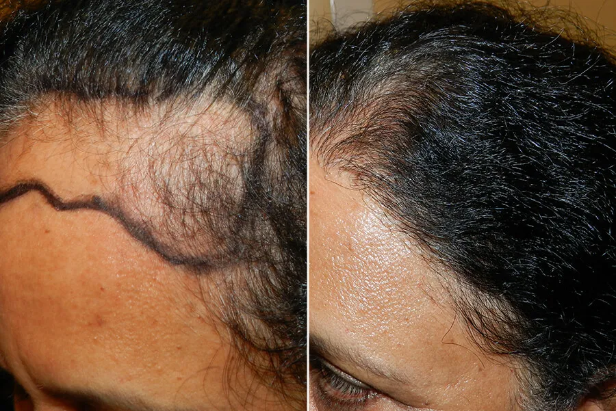hair implants for women
