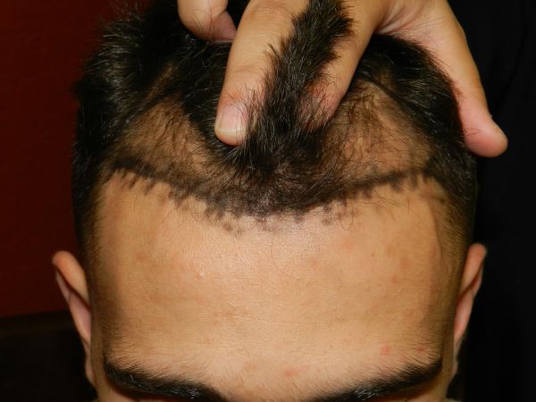 FUT vs FUE Hair Transplants: Which One is Right for Me?