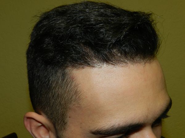 Hairline Surgery San Jose 