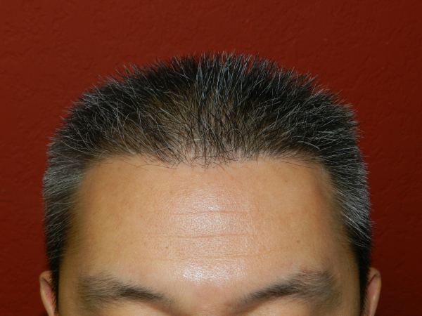fue hair transplant after