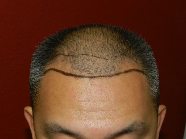 hair-implant-surgery-for-men