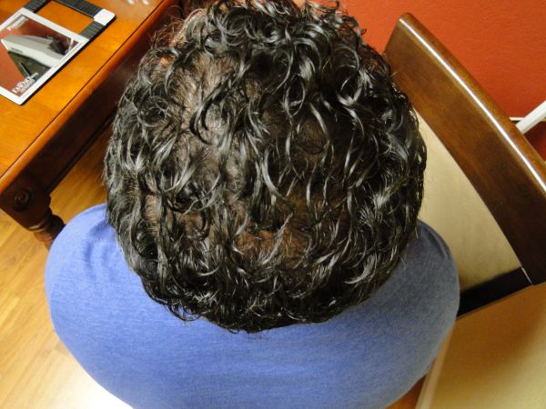 After- Bald treatment in San Jose