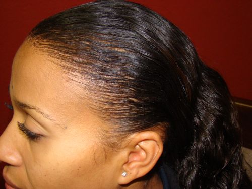 african american hair transplant bay area 