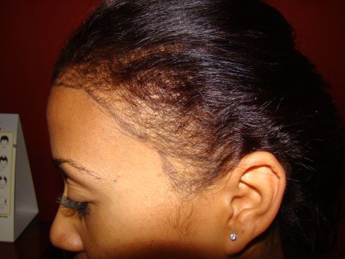 african american hair transplant doctor san jose