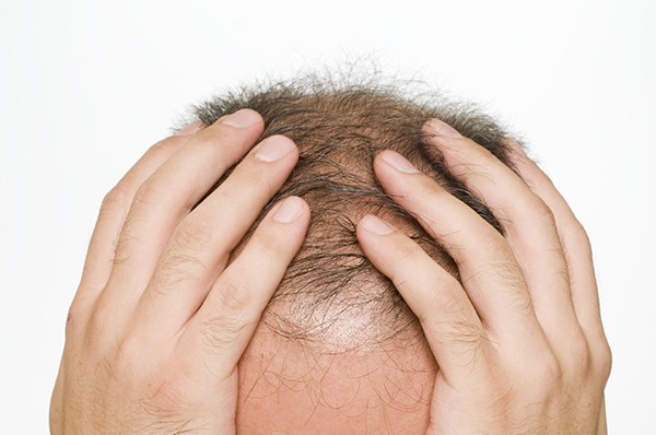 Hair Transplant Bay Area