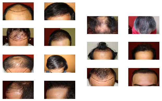 Hair Plugs repaired by FUE Doctor San Jose