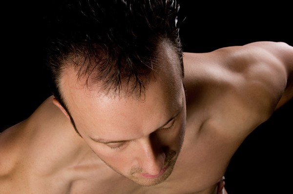View of San Jose man's thinning hair from top