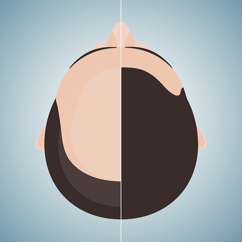 What to Expect hair transplant